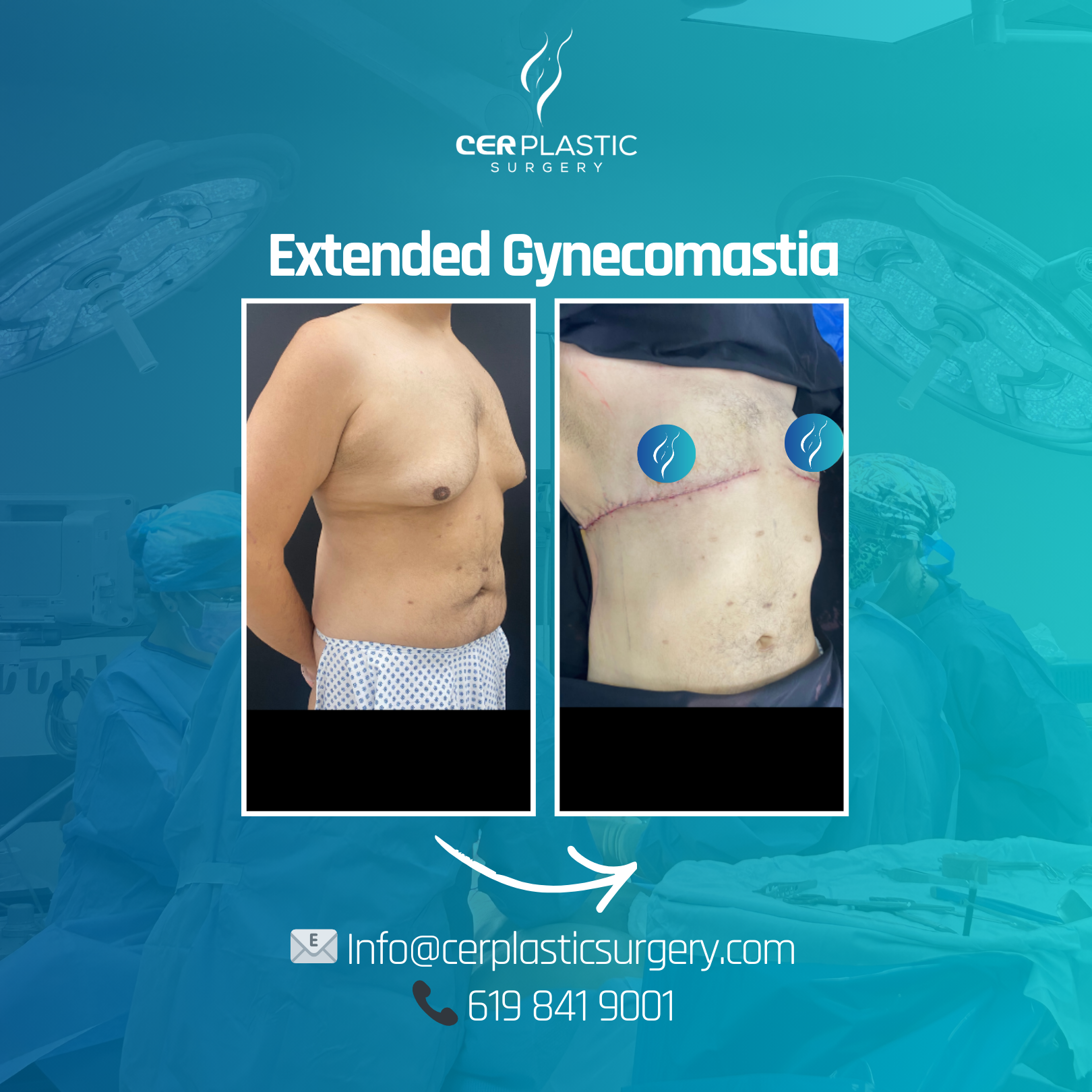 Patient before anf after extended gynecomastia