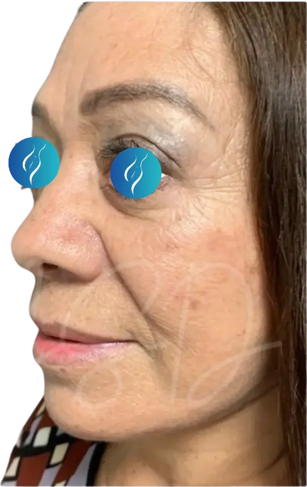 After, example case