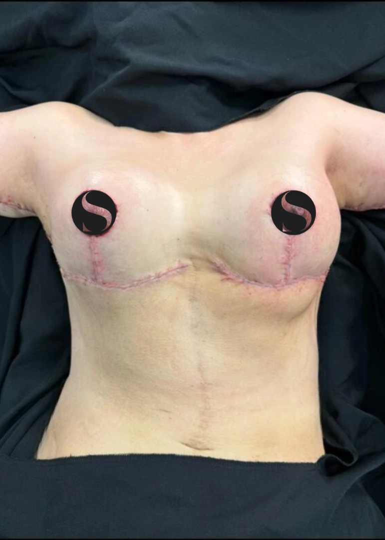 After, example case