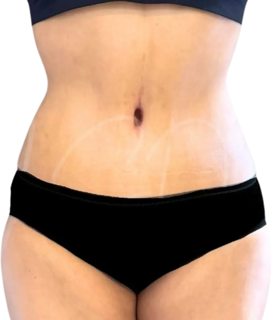 After, example case