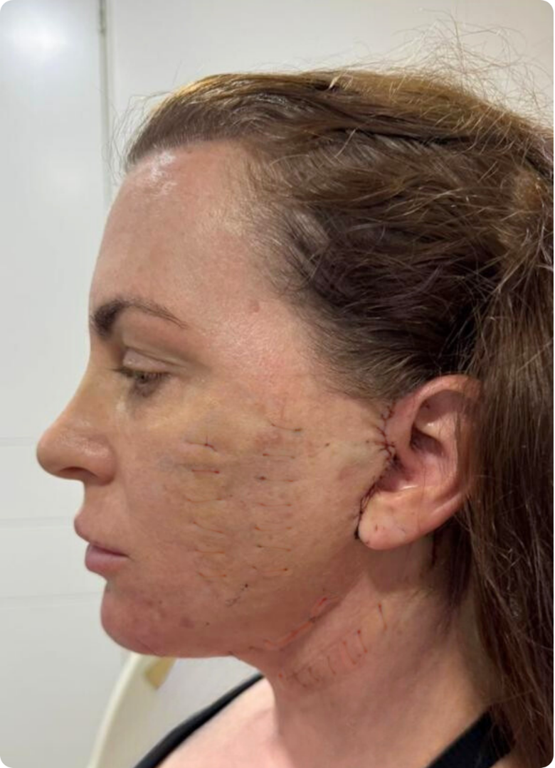 After facelift surgery