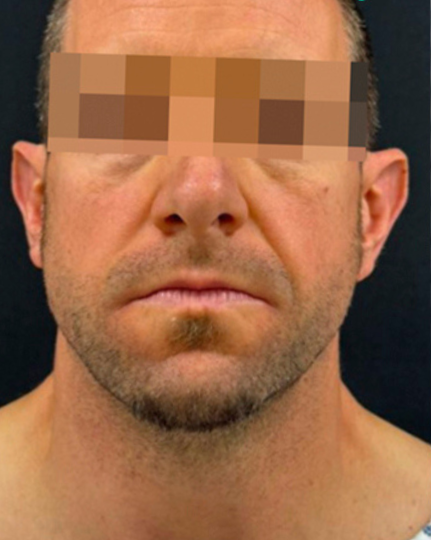 Before Rhinoplasty