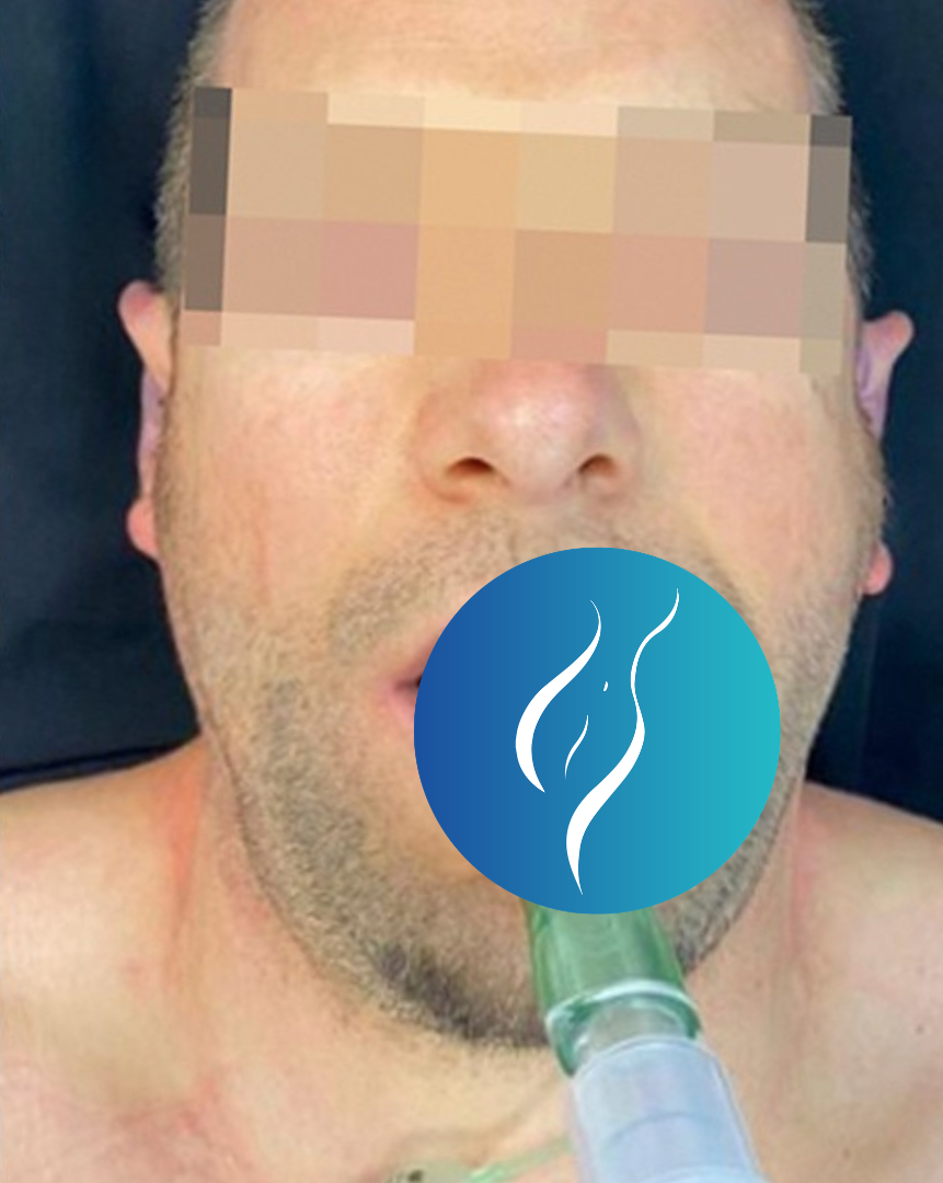 After Rhinoplasty