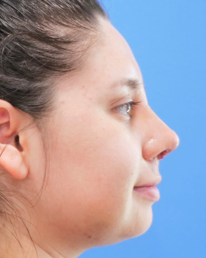 After Rhinoplasty