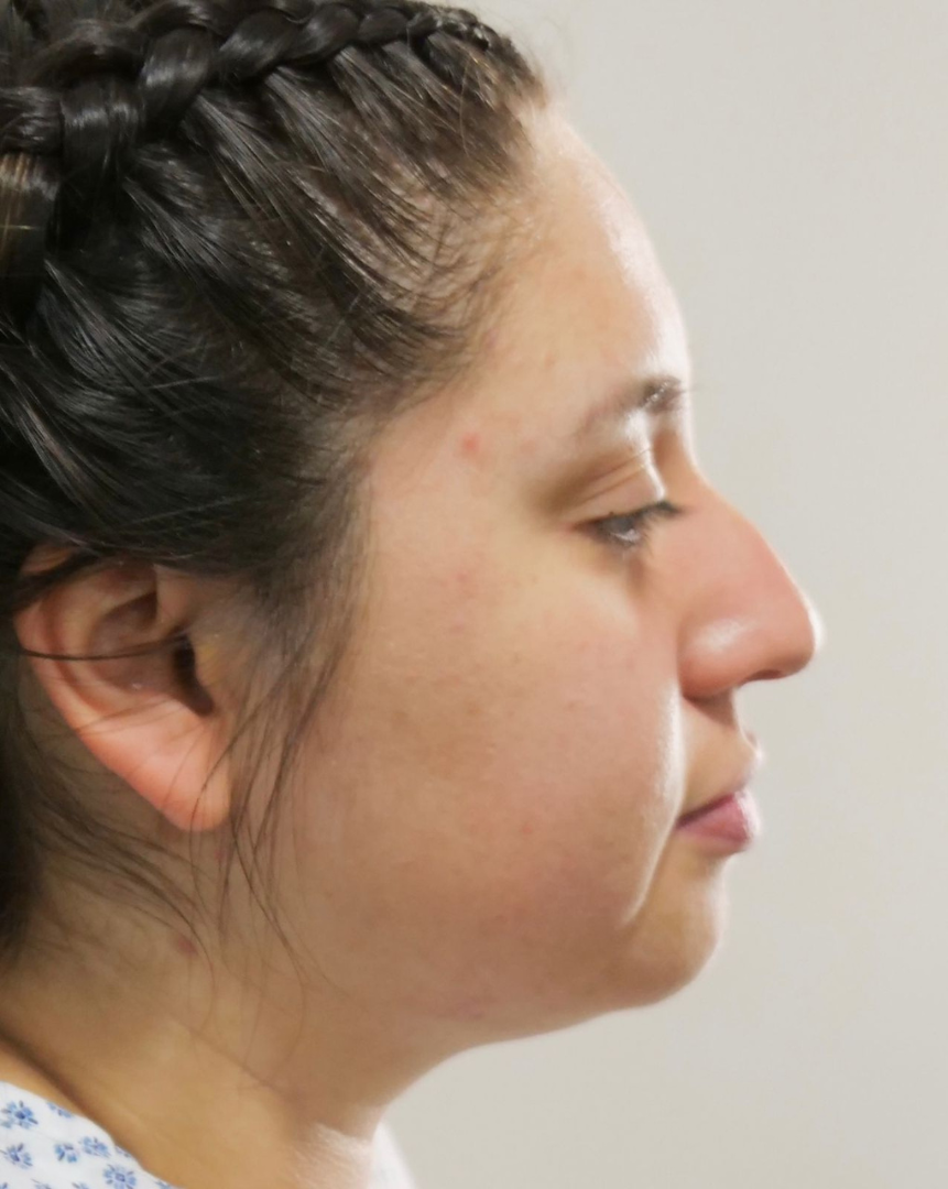Before Rhinoplasty